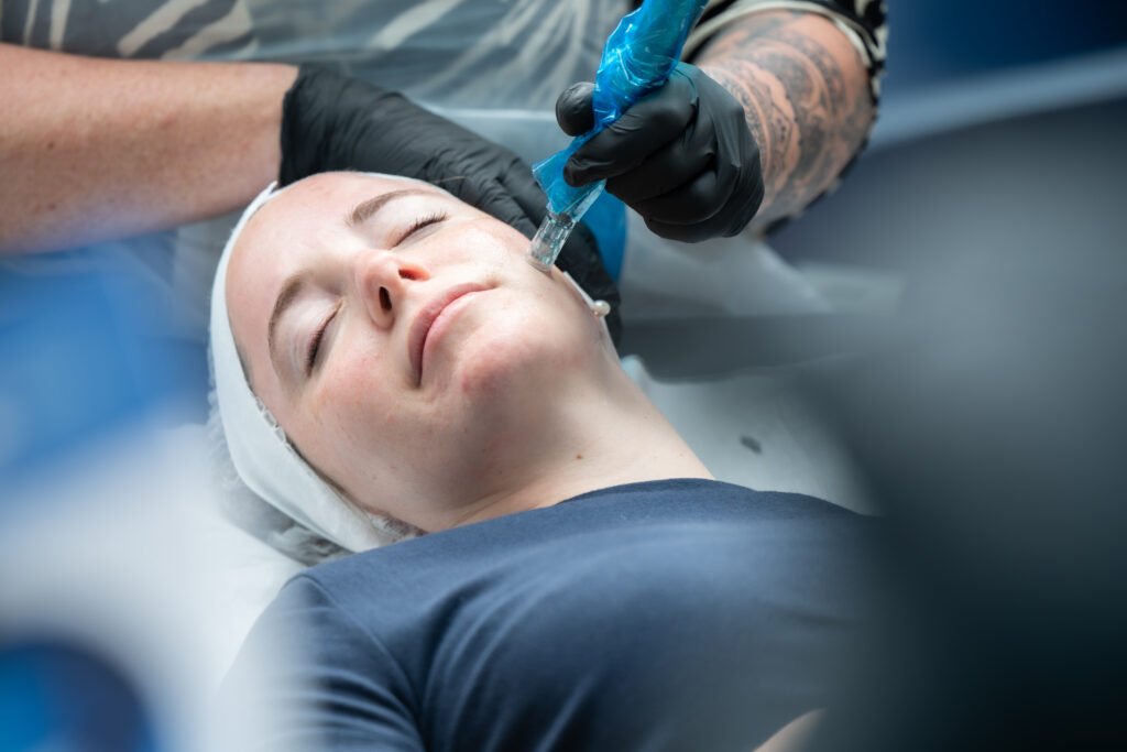 Regenerative aesthetics microneedling treatment using Celltermi Revive NX Exosomes to support skin longevity, collagen stimulation and natural rejuvenation.